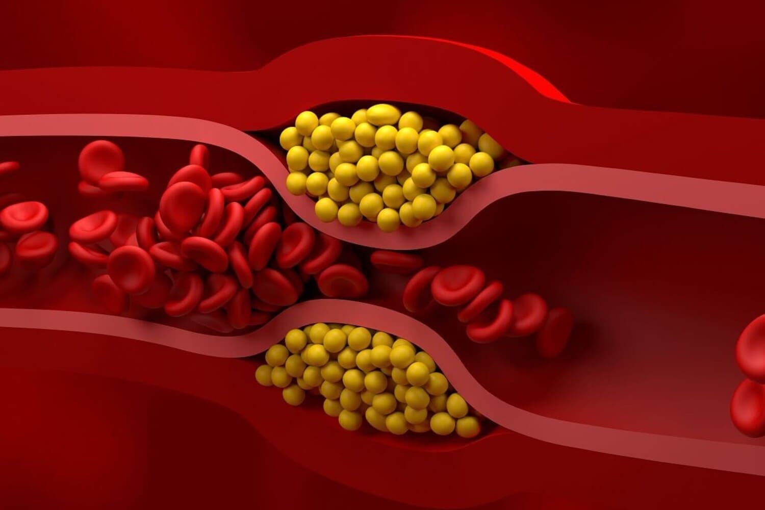 ilustrasi kolesterol jahat. (Freepik) - Image